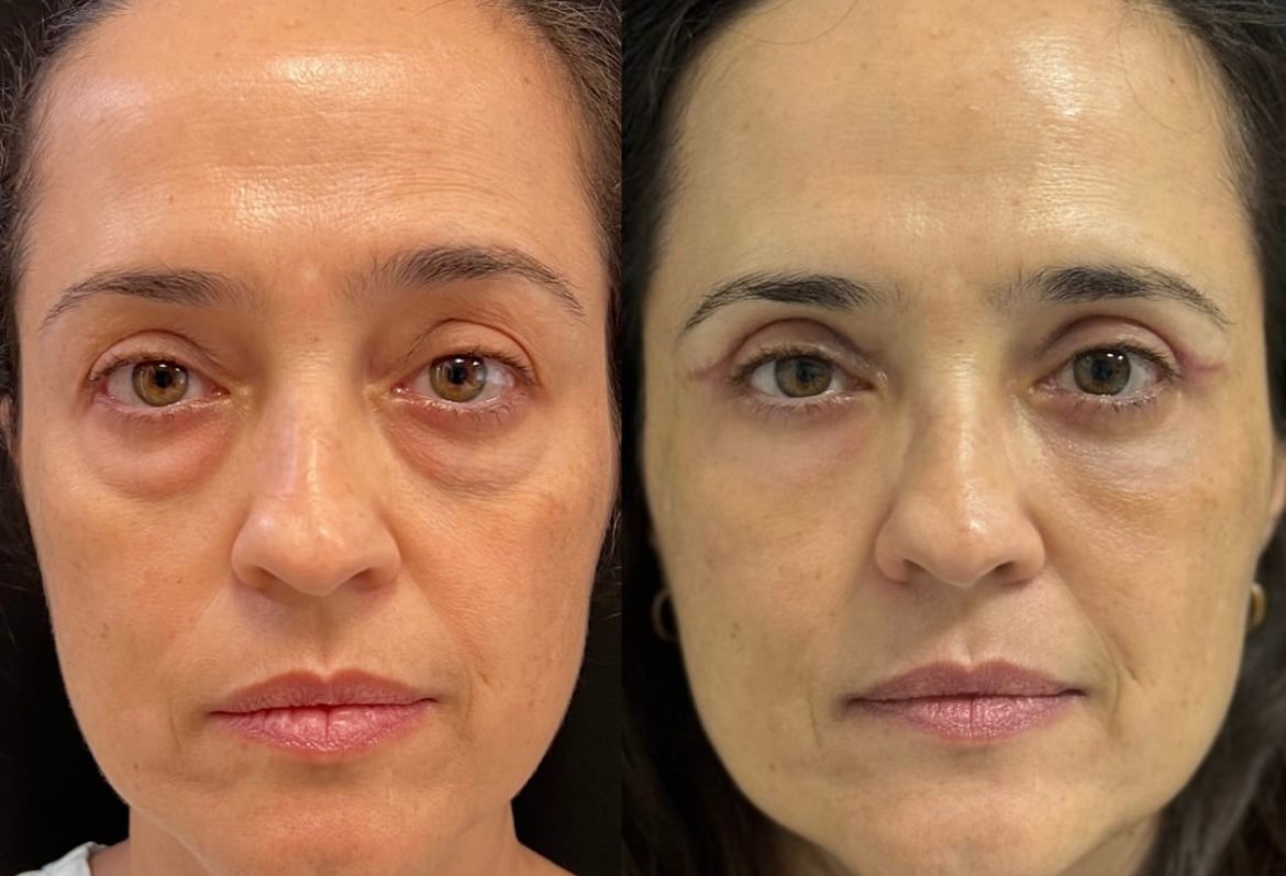 Antes e Depois de Temporal Lift realizado por Dr. Tiago Ortiz